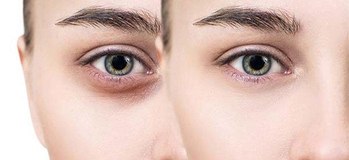 علت سیاهی زیر چشم چیست و چطور آن را درمان کنیم؟